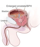 Enlarged prostate - BPH showing the urinary tract