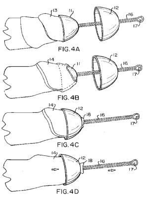 Figures 4a to 4d from the Tug Ahoy foreskin restoration device patent